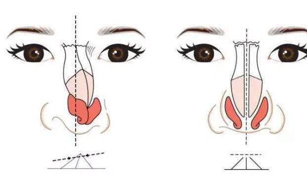 做隆鼻手術(shù)想要修復的話可以完全清除掉嗎？
