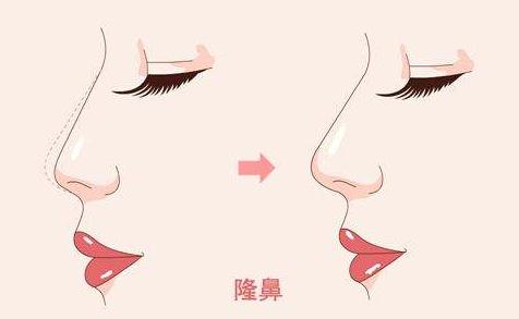 做隆鼻手術(shù)想要修復的話可以完全清除掉嗎？