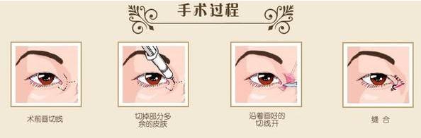 朋友說開外眼角后遺癥多，是真的嗎？