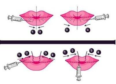 玻尿酸豐唇后多久能接吻？打開kiss的正確方式！