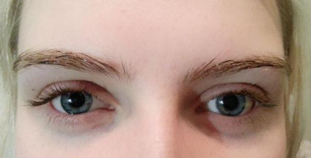 開(kāi)眼角手術(shù)的后遺癥和禁忌人群，都要了解一下~