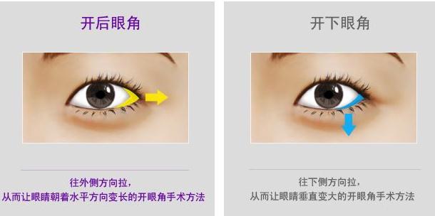 開(kāi)眼角手術(shù)的后遺癥和禁忌人群，都要了解一下~