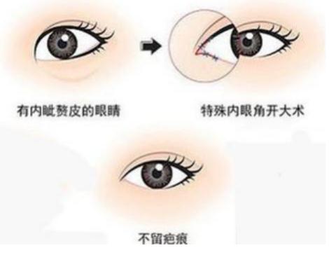 開(kāi)眼角手術(shù)的后遺癥和禁忌人群，都要了解一下~