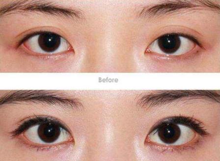 開(kāi)眼角手術(shù)的后遺癥和禁忌人群，都要了解一下~