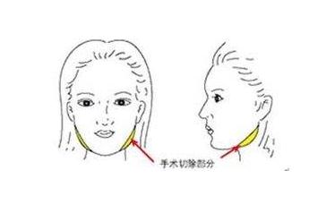 想知道磨骨瘦臉手術(shù)風(fēng)險大不大？看完后遺癥就知道了
