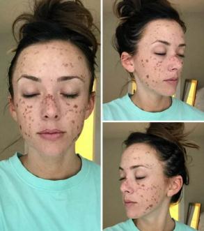 做激光祛斑手術(shù)的時(shí)候，為什么會(huì)有一股燒焦的味道？