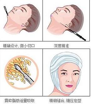 還在猶豫要不要做雙下巴吸脂？你在擔(dān)心后遺癥嗎？