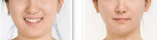 還在猶豫要不要做雙下巴吸脂？你在擔(dān)心后遺癥嗎？