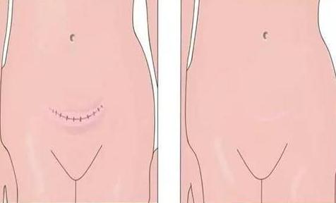 剖腹產(chǎn)疤痕增生應該怎樣祛除？激光有嗎？