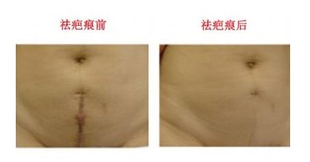 剖腹產(chǎn)疤痕增生應該怎樣祛除？激光有嗎？