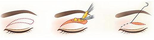 割了雙眼皮眼睛依舊沒有神？可能是沒有開眼角哦！