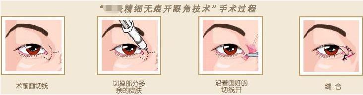 割了雙眼皮眼睛依舊沒有神？可能是沒有開眼角哦！