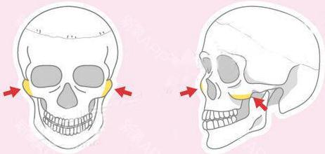 怎么磨顴骨？原來手術(shù)的過程是這樣的！
