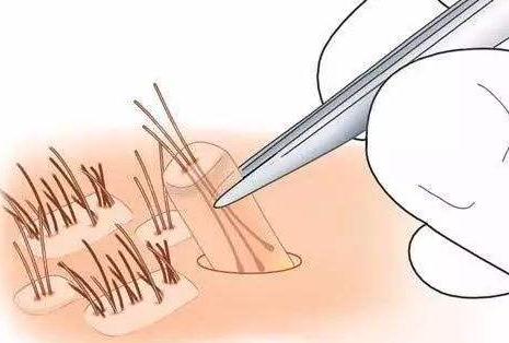 頭發(fā)種植術(shù)多少錢?怎么收費(fèi)?