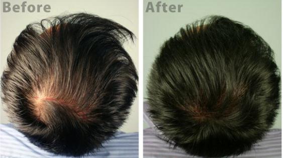 頭發(fā)種植術(shù)多少錢?怎么收費(fèi)?