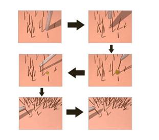頭發(fā)種植要多久才能恢復(fù)？