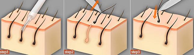 頭發(fā)種植多少錢？一個(gè)單位多少錢？