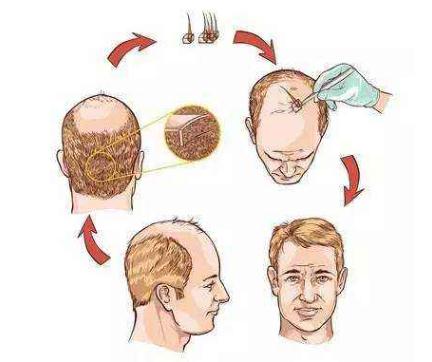 頭發(fā)種植多少錢？一個(gè)單位多少錢？