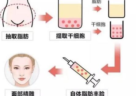 張敏醫(yī)生脂肪填充