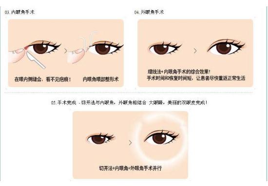 北京眼部手術(shù)比較好的醫(yī)生有哪些？優(yōu)質(zhì)醫(yī)生名單