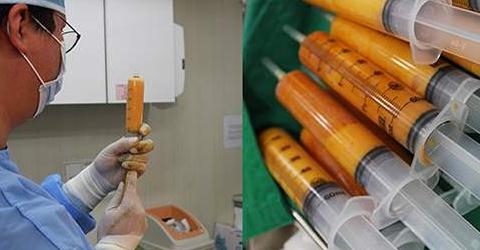 面部脂肪填充十年后是什么樣子？臉會(huì)塌陷嗎？