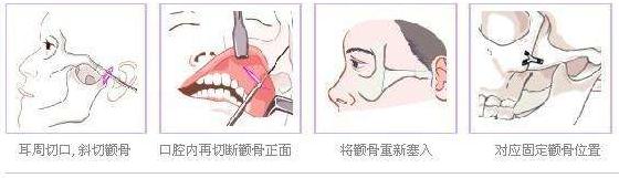 上海顴骨整形哪家醫(yī)院好？看看有心儀的沒(méi)~