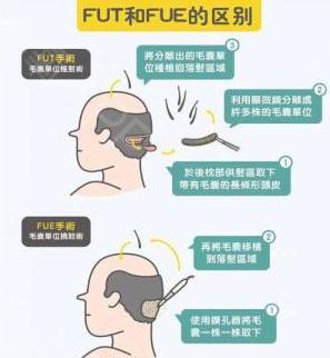 微創(chuàng)植發(fā)的果怎么樣?