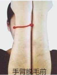 冰點(diǎn)脫毛的副作用