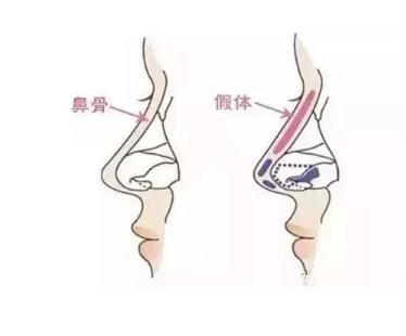 兩者術(shù)中塑形性進行比較