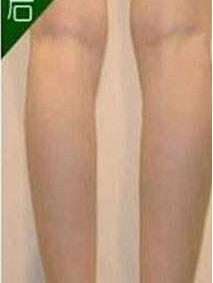 瘦腿吸脂的果好嗎？