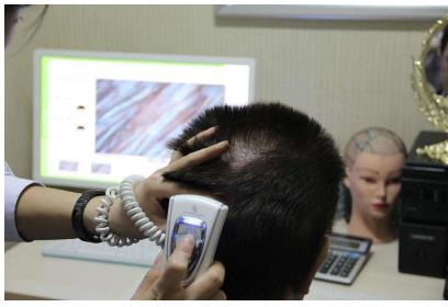 毛發(fā)移植前準備