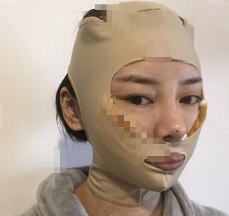 顴骨顴弓整形的方法