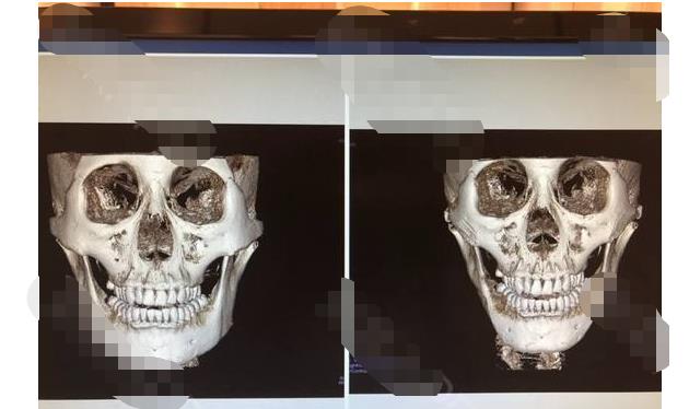 關(guān)于顴骨顴弓整形的手術(shù)方法，你了解多少呢？