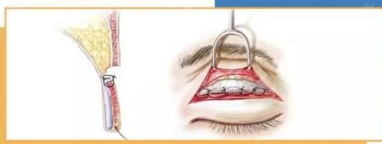 歐式雙眼皮手術(shù)