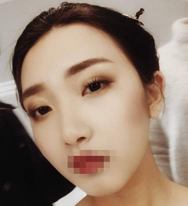 歐式雙眼皮手術(shù)恢復(fù)期時(shí)間有多長(zhǎng)?