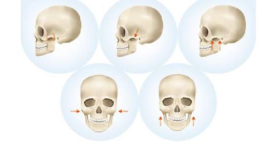臨床上進行顴骨整形手術的過程主要有