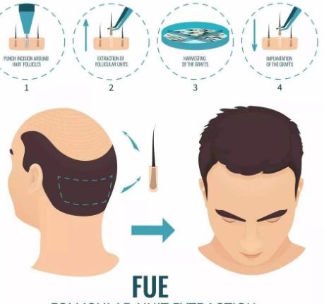 禿頂可不可以移植呢?