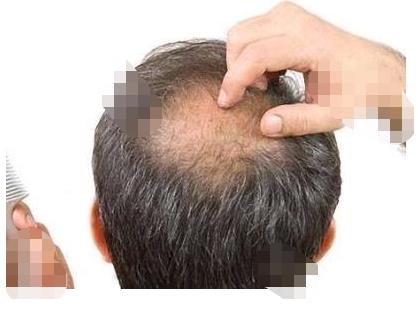 禿頂能植發(fā)嗎？拯救你的“地中?！?！