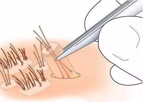 植發(fā)調(diào)節(jié)的條件?