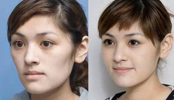 面部脂肪填充能維持多長時間？