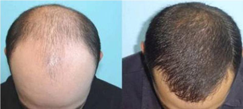 植發(fā)補(bǔ)發(fā)的過(guò)程