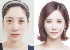 面部脂肪填充后遺癥是什么？怎樣避免后遺癥？