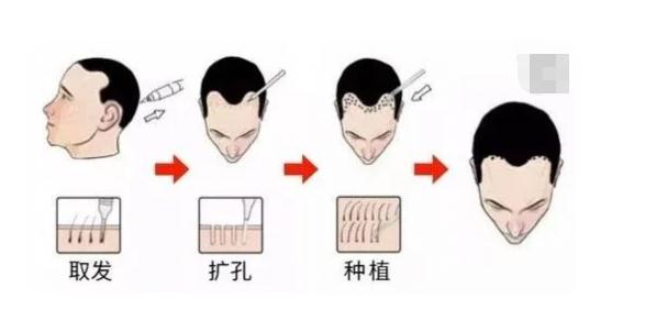 新發(fā)現(xiàn)植發(fā)連鎖機構(gòu)