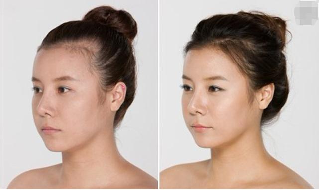 補(bǔ)發(fā)植發(fā)是真的有嗎？受大眾歡迎是有原因的！