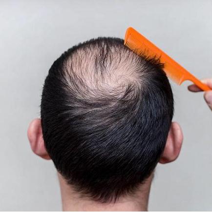 植發(fā)與補(bǔ)發(fā)哪一個好了?