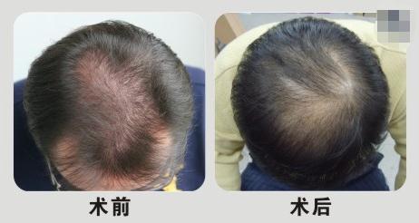 杭州植發(fā)醫(yī)院哪家好？如何挑選正規(guī)的醫(yī)院？