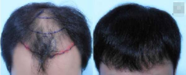 杭州毛發(fā)移植醫(yī)院哪家好?毛發(fā)移植醫(yī)院之間的區(qū)別