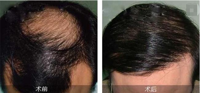 杭州毛發(fā)移植醫(yī)院哪家好，如何選擇？