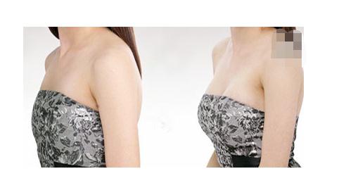 哪些癥狀必須得做隆胸失敗修復手術？