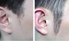 種植鬢角需要多少根毛囊？承接胡須的“中場(chǎng)地